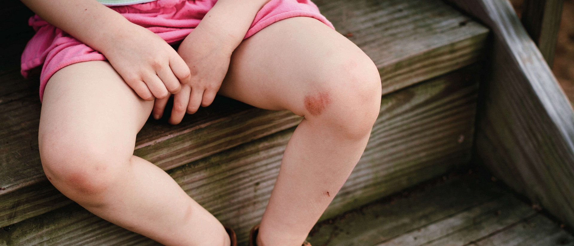 Beine eines Kindes in Sommerbekleidung mit Neurodermitis am Knie auf einer Holztreppe 