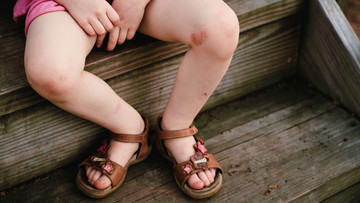Beine eines Kindes in Sommerbekleidung mit Neurodermitis am Knie auf einer Holztreppe 